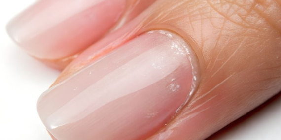 El Tırnak Şekil Bozukluğu Nasıl Düzelir?