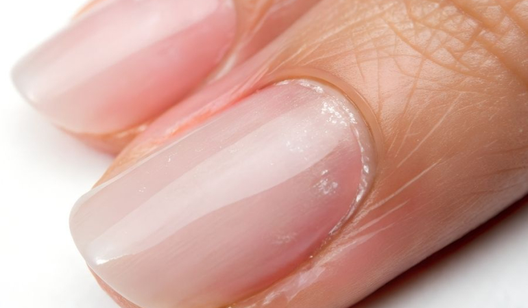 El Tırnak Şekil Bozukluğu Nasıl Düzelir